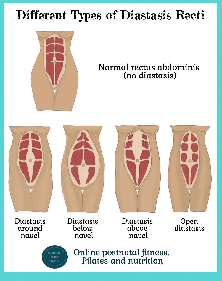 different types of diastasis recti